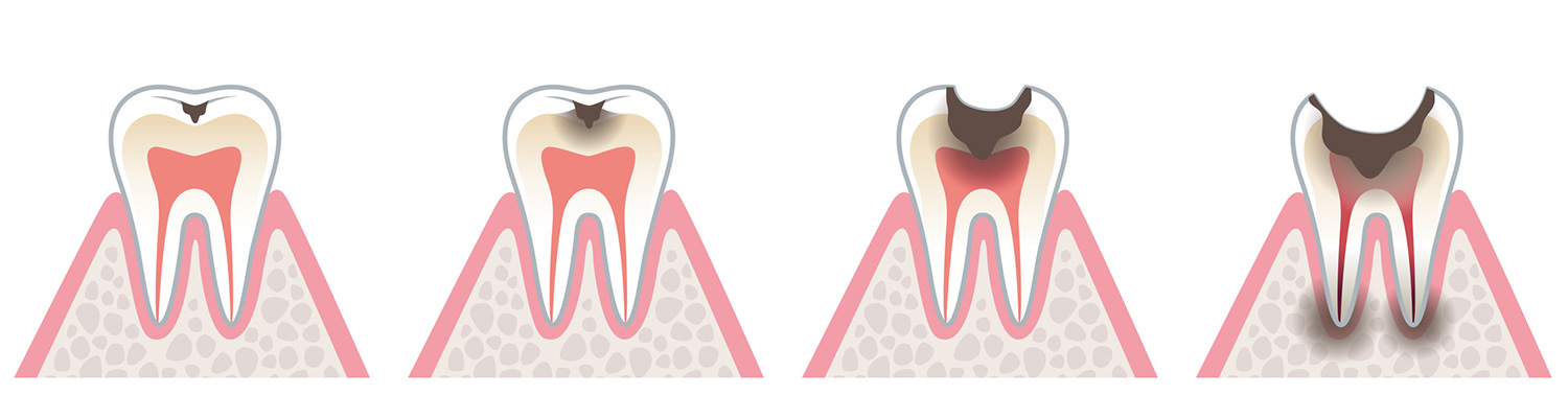 むし歯の進行と症状
