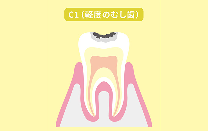 C1（初期のむし歯）