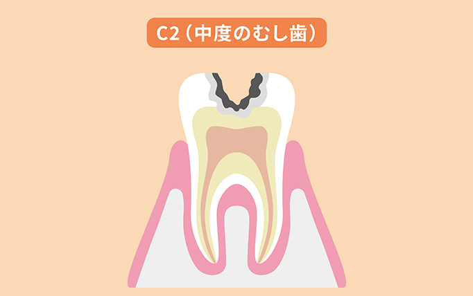 C2（象牙質まで進行したむし歯）