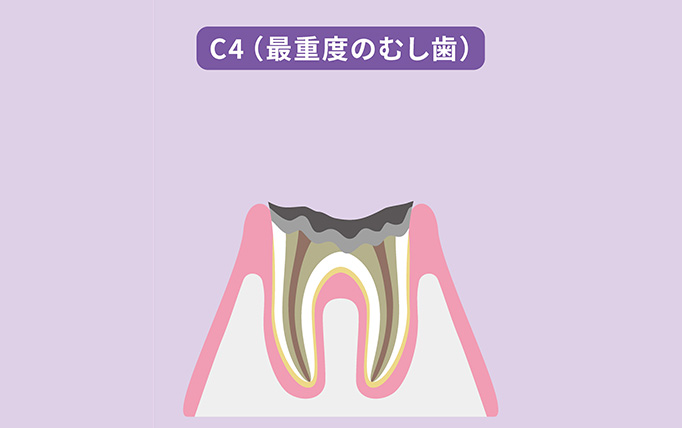 C4（抜歯が必要なむし歯）