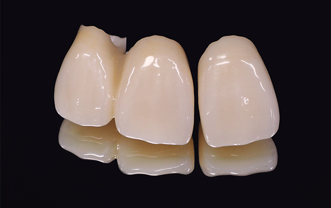 セラミッククラウン