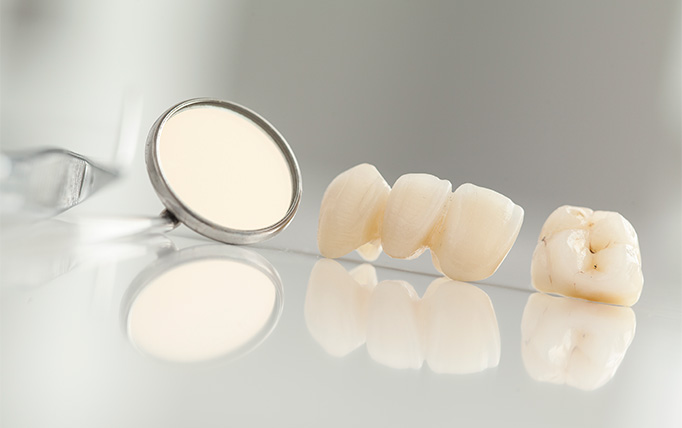 被せ物の製作と装着